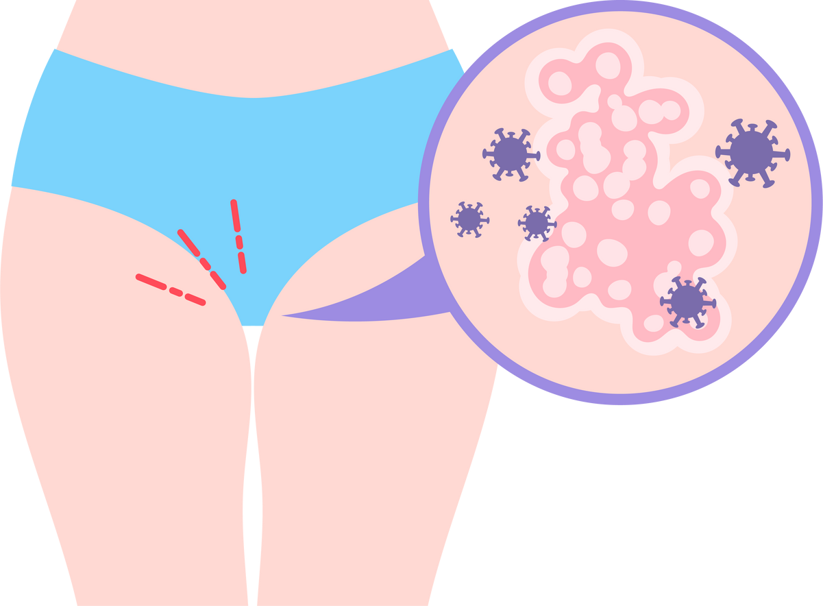 examination HIV and HPV virus vagina cancer lice Human women odor pap smear test exam Papilloma parasites safe pain cervix yeast Itching warts